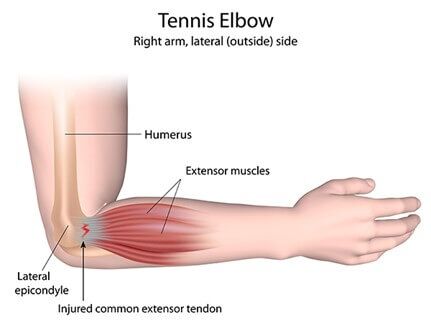 Understanding Tennis and Golfer's Elbow: Causes & Treatments ...