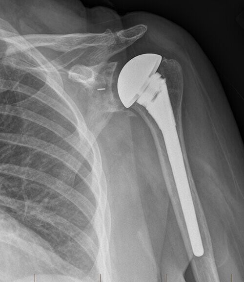 Shoulder Replacement - Orthopaedic Surgeon Adelaide Providing Quality ...