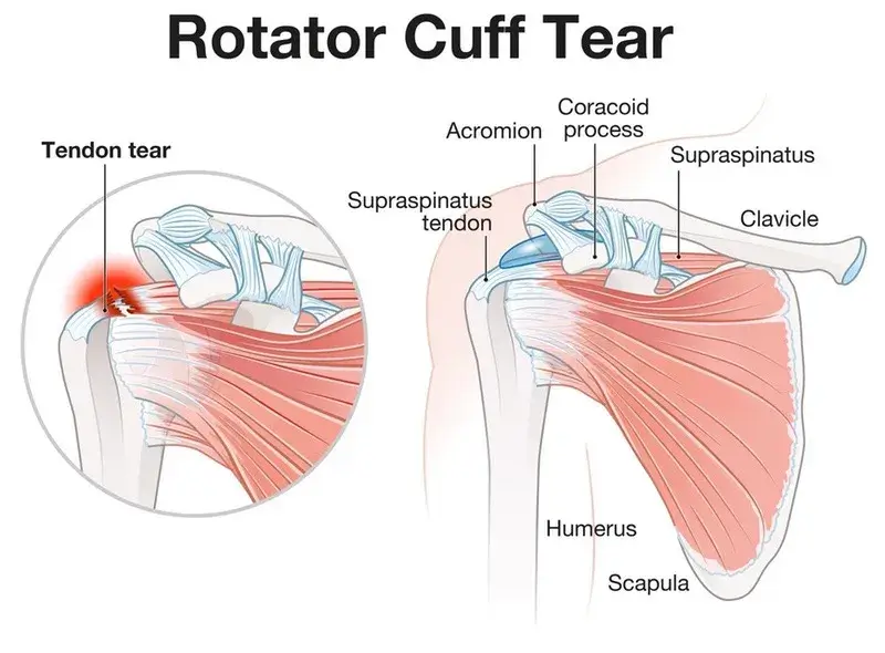 Rotator Cuff Tears: Causes, Symptoms & Treatment - Orthopaedic